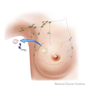 breast-biopsy-129010.jpg