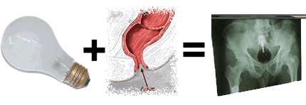 bulb_anus_xray.gif