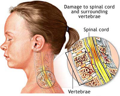 spinal-cord-injury.jpg
