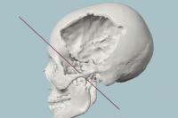 malala_Gunshot Wound